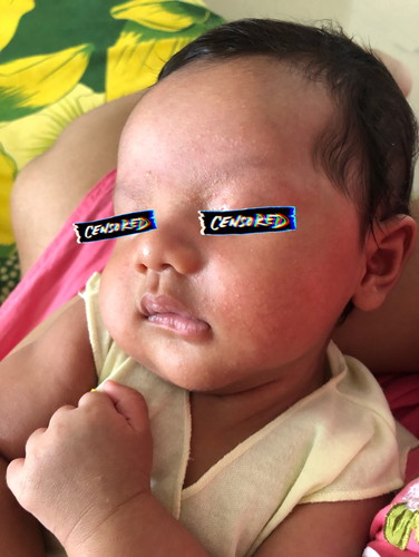 muka bayi bintik-bintik