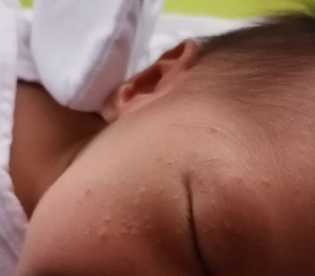 Rashes Sa Face Ni Baby 2weeks Old