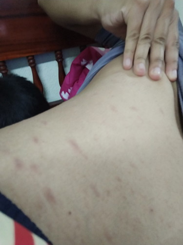ผื่นทั้งตัว