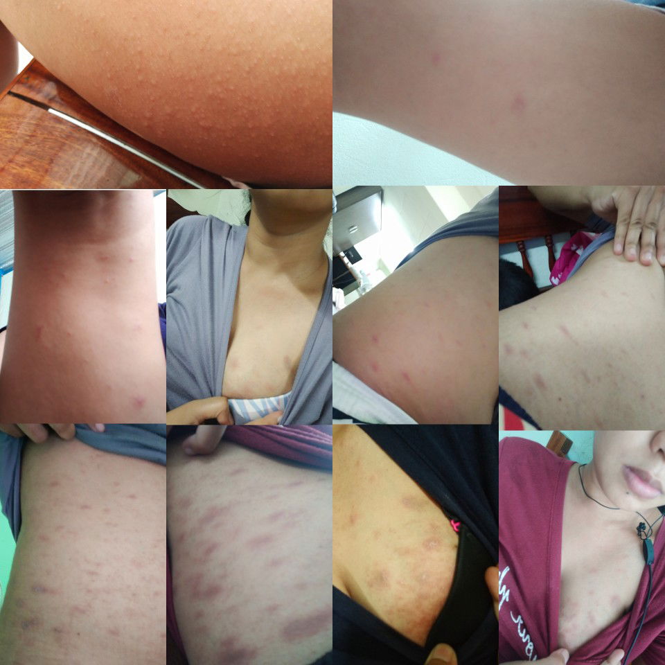 เป็นผื่นขึ้นทั้งตัว