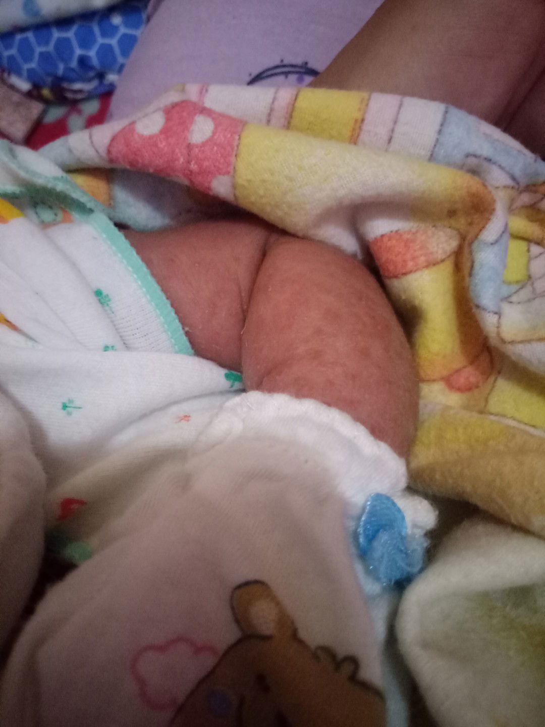 kulit tangan bintik merau