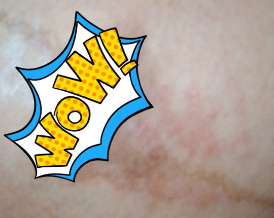 ruam merah gatel diperut