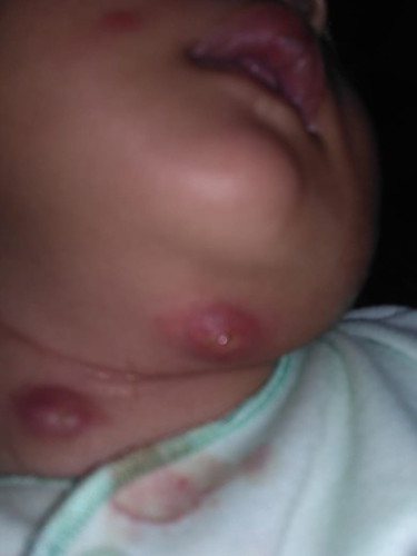 bisul di bayi