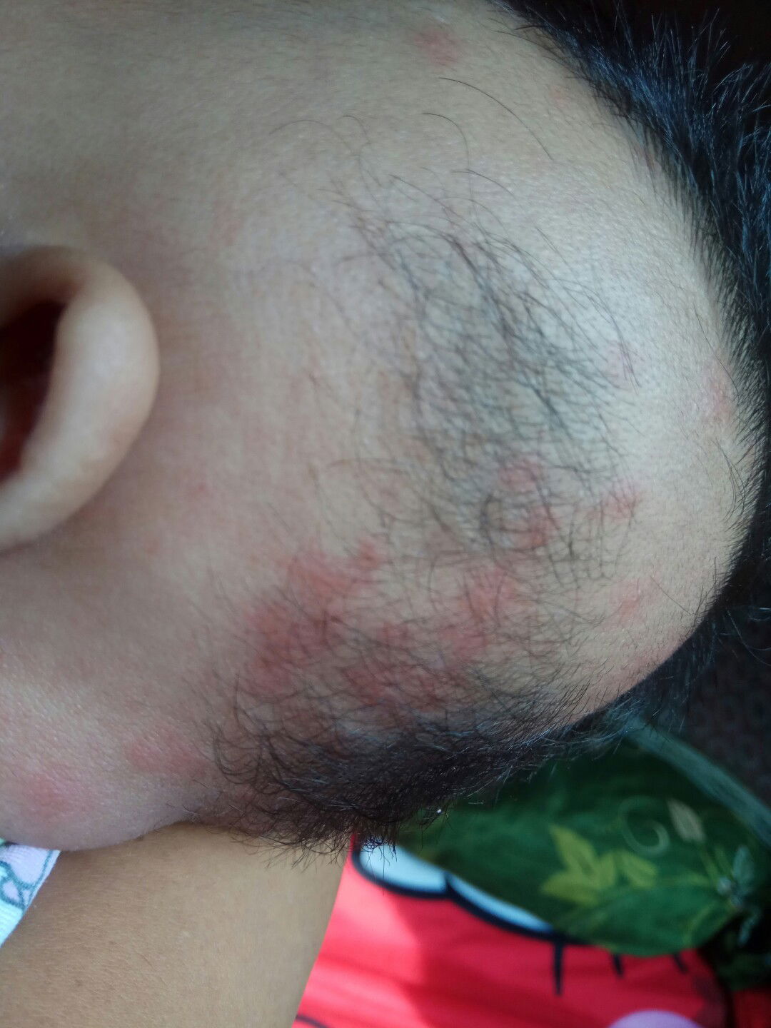 Bentol Merah Di Kepala Bayi