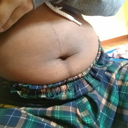 แม่หลังคลอดได้ 18 วันค้ะ หน้าท้องดำปี๋ แห้งๆเหี่ยวๆ แม่ๆมีวิธีไหนช่วยได้บ้างค้ะ ใครเจอแบบนี้บ้าง?