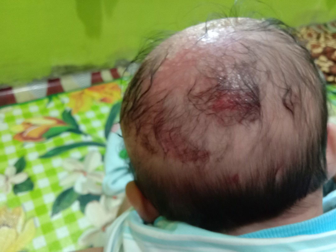 bunda kepala anak saya kemerahan dan berair serta bau amis juga, kira2 apa ya ??