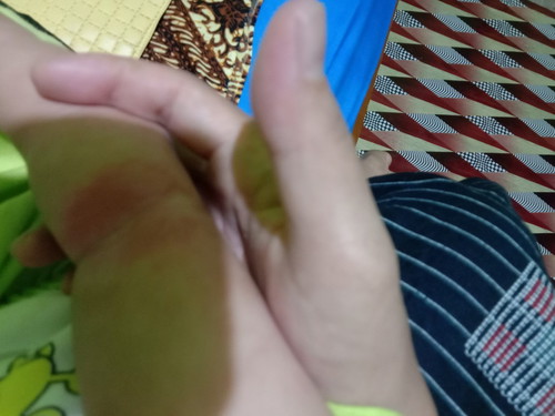 bunda kira2 salep apa ya obat tangan anakku ini, soalnya sudah pakai sabun lactasid dan caladine lotion gk sembuh2 juga?