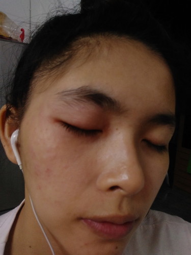 คันตาแล้วมีแบบนี้ขึ้นตกใจมากคะ