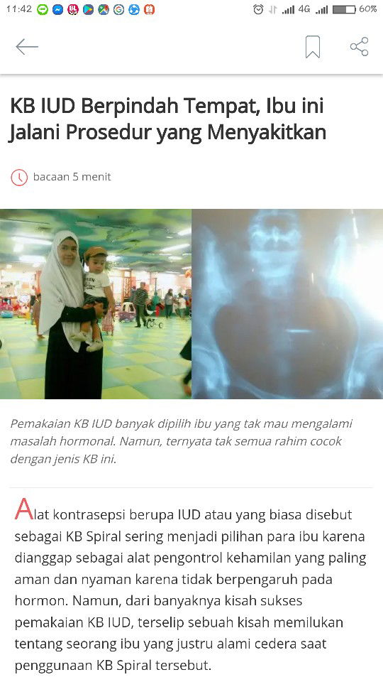 Kb IUD