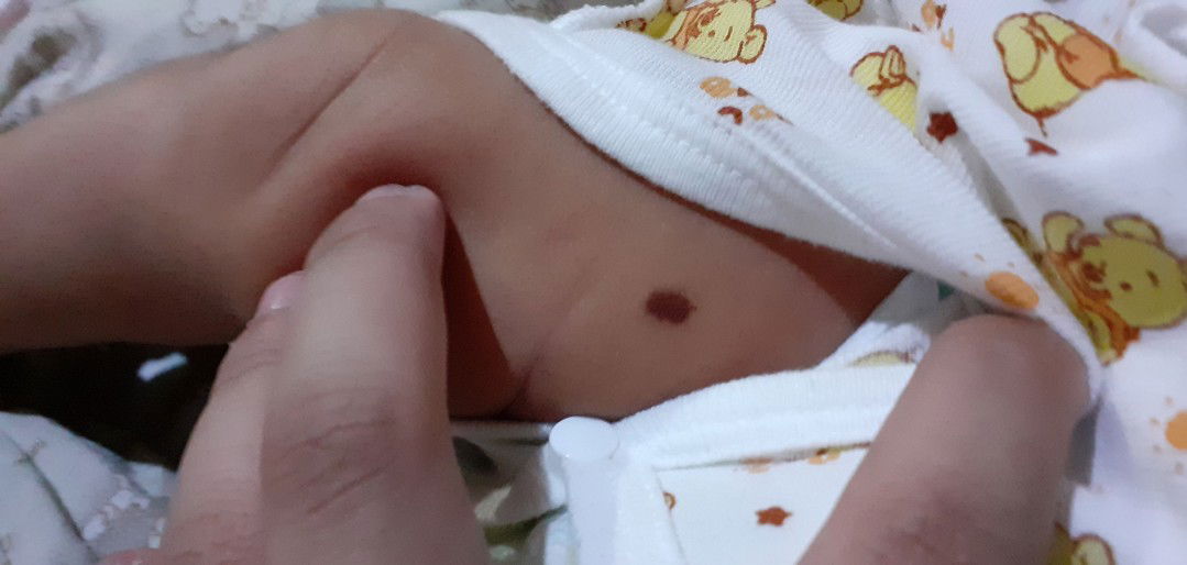 Is this a Mole or Birthmark?