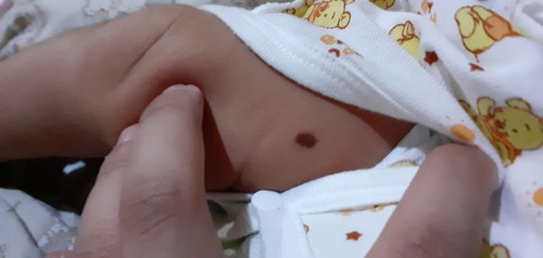 Is this a Mole or Birthmark?