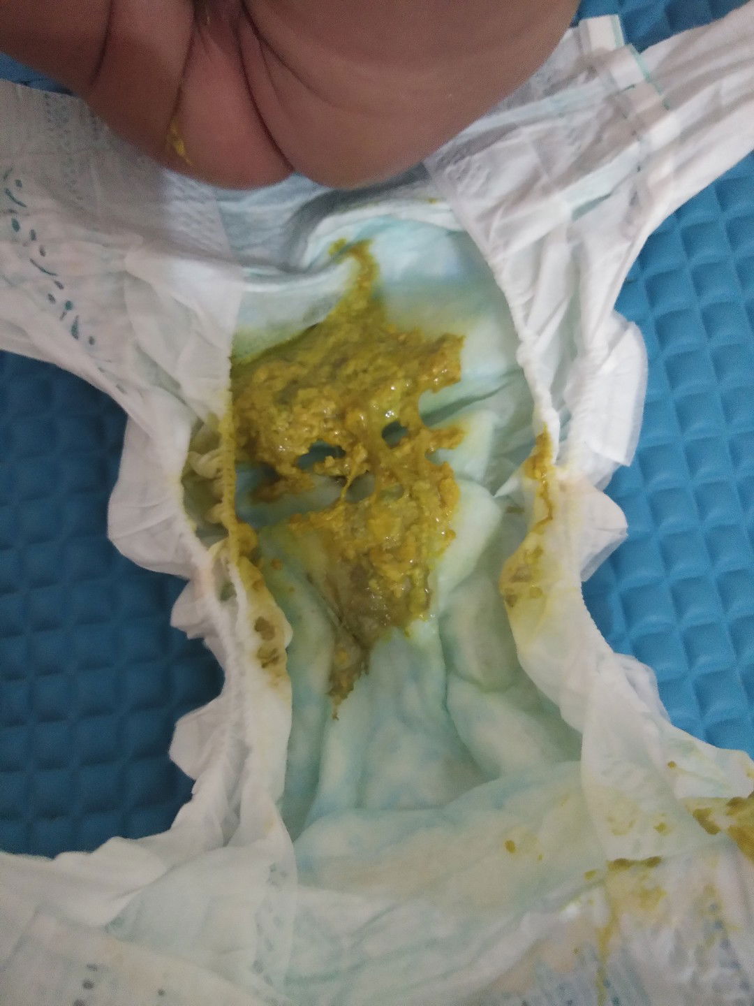Watery yellow green poop ni baby