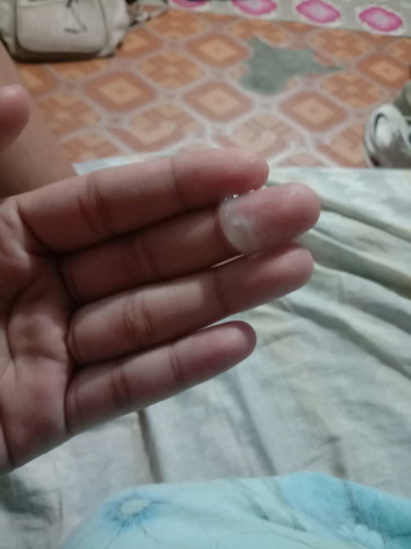 Discharge (Pasintabi po sa mga kumakain)