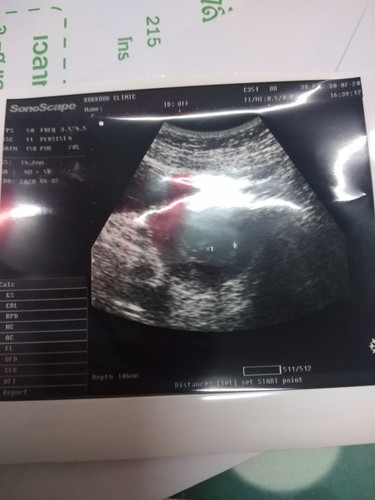 ขอดูใบซาวน์ของแม่ๆอายุครภภ์4วีคหน่อยค่ะเจอตัวร้องกันยังคะ