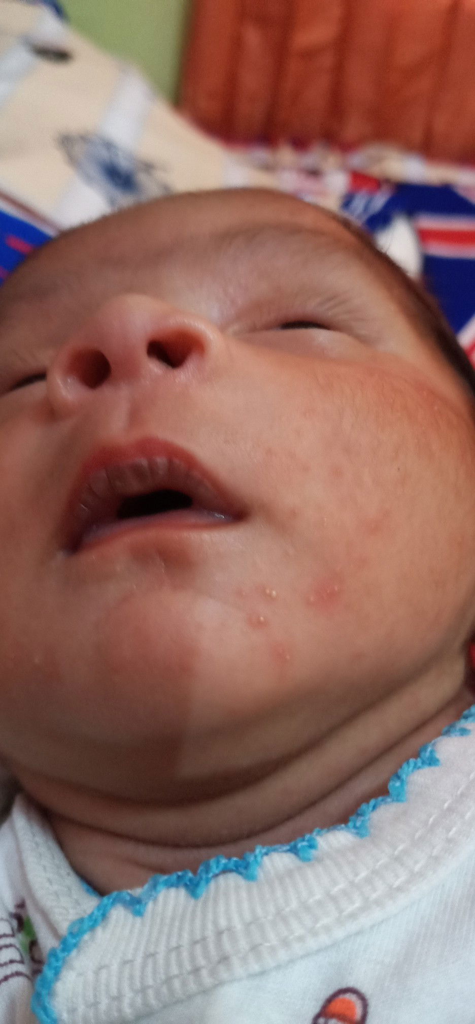 Pipi Bayi merah dan Bruntusan