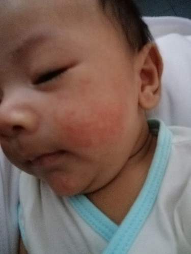 Rashes