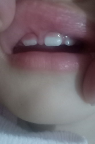 Baby tooth
