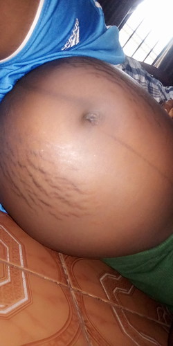 stretch marks