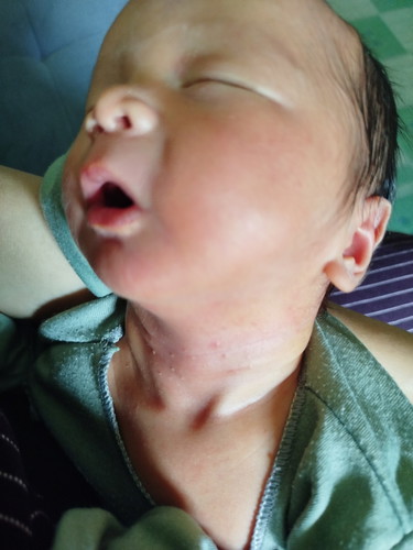 Bun kalo ada bintik2 gini harus dikasih apa y,bayi nb baru 6hari