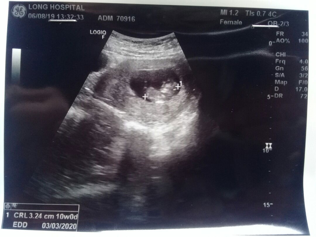 ในที่สุดก็ได้เห็นตัวเล็ก ❤