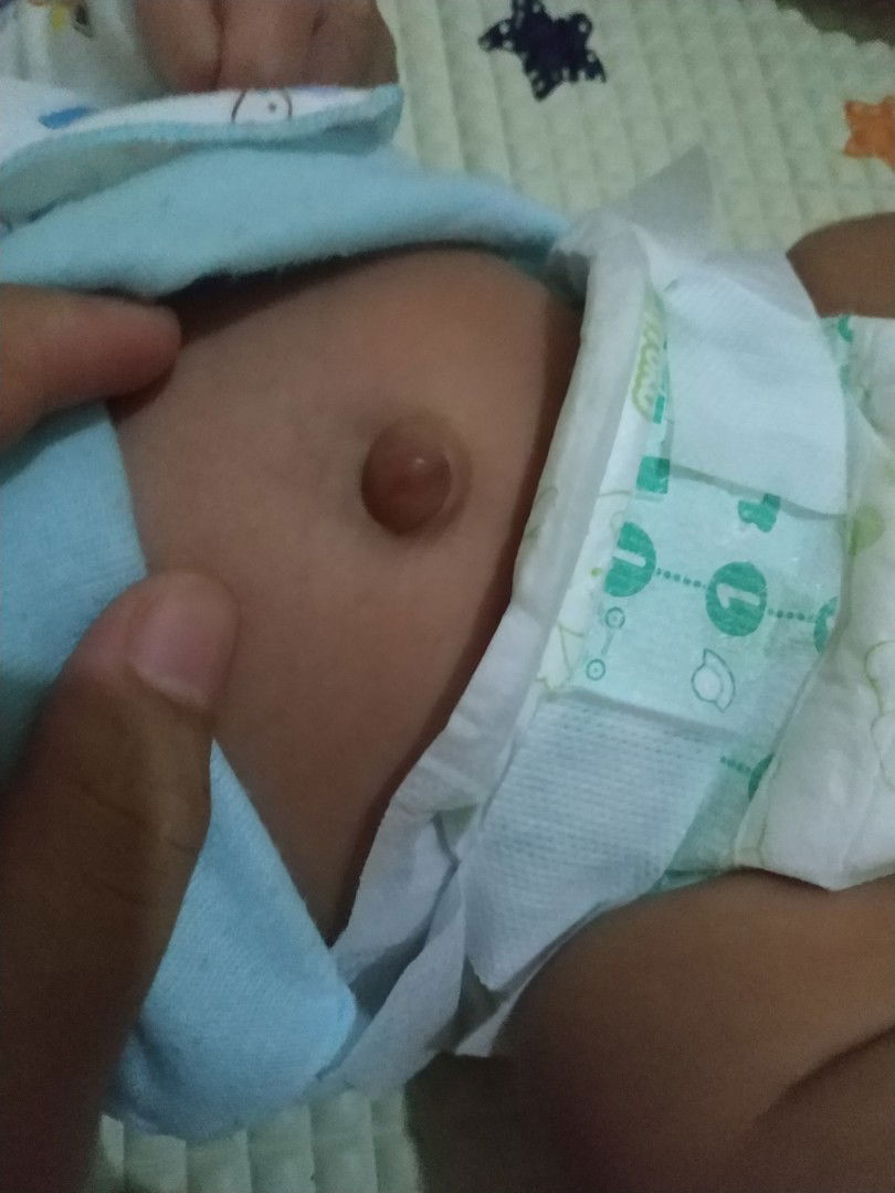 Pusar Bodong pada bayi