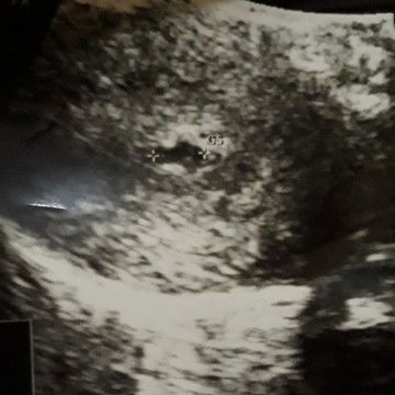 kehamilan Usia 5 week