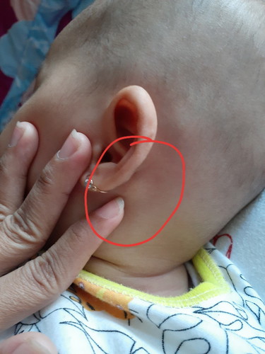 benjolan belakang telinga?