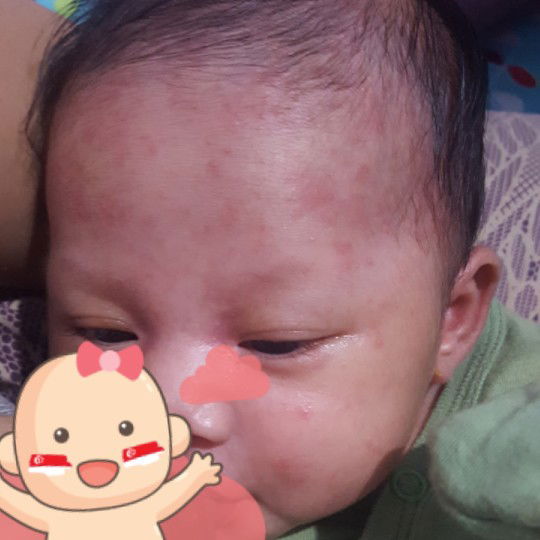 merah merah pada bayi