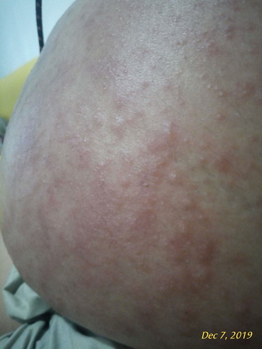 rashes