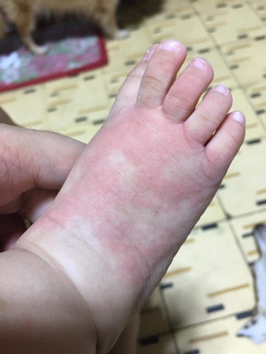 INSECT BITE OR RASH?