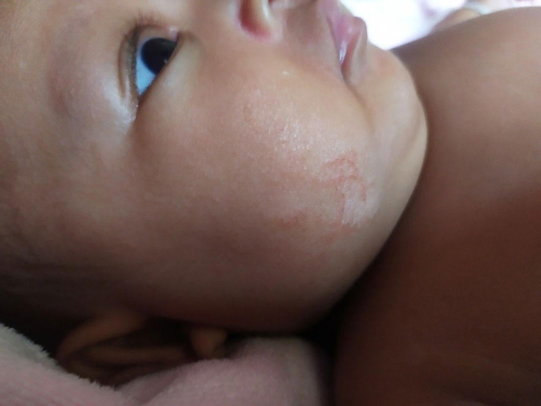 เป็นเกลื้อนน้ำนมหรือเปล่า