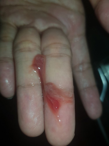 blood discharge