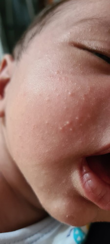 baby acne? heart rash?