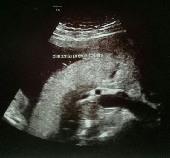 รกเกาะต่ำ