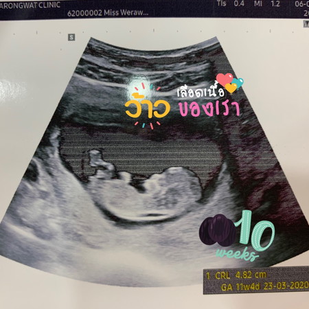 เห็นนู๋เป็นรูปร่างแล้ว 10Week5Day