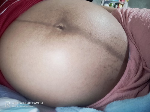 Stretch Marks at 31 weeks and 3days