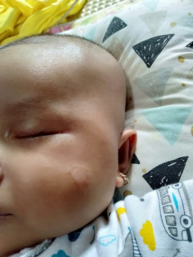 ruam susu