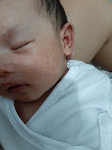 RASHES