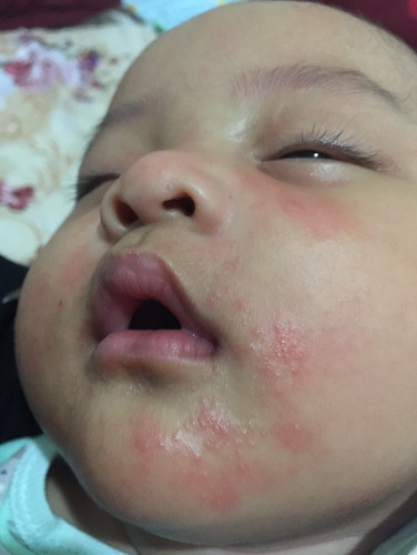 Ruam seputar mulut bayi 6bulan