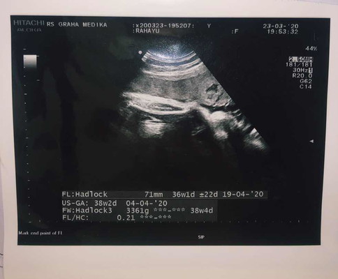 Lahir dengan Induksi