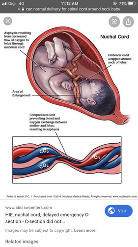 Anyone proceed with normal delivery no complication ?
