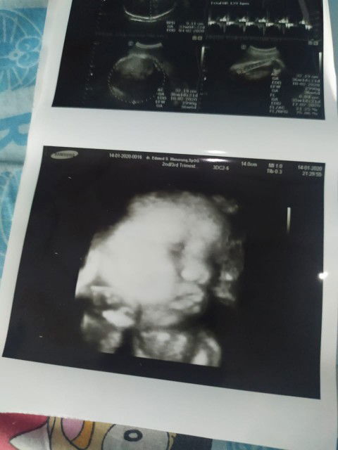 1 lilitan tali pusar