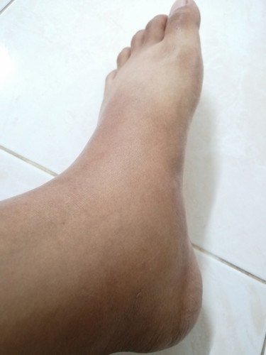 เท้าบวม
