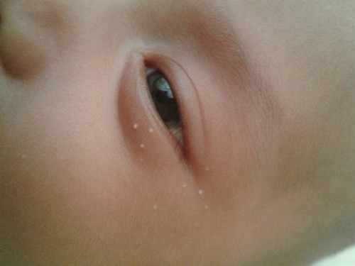 Bintik putih di wajah