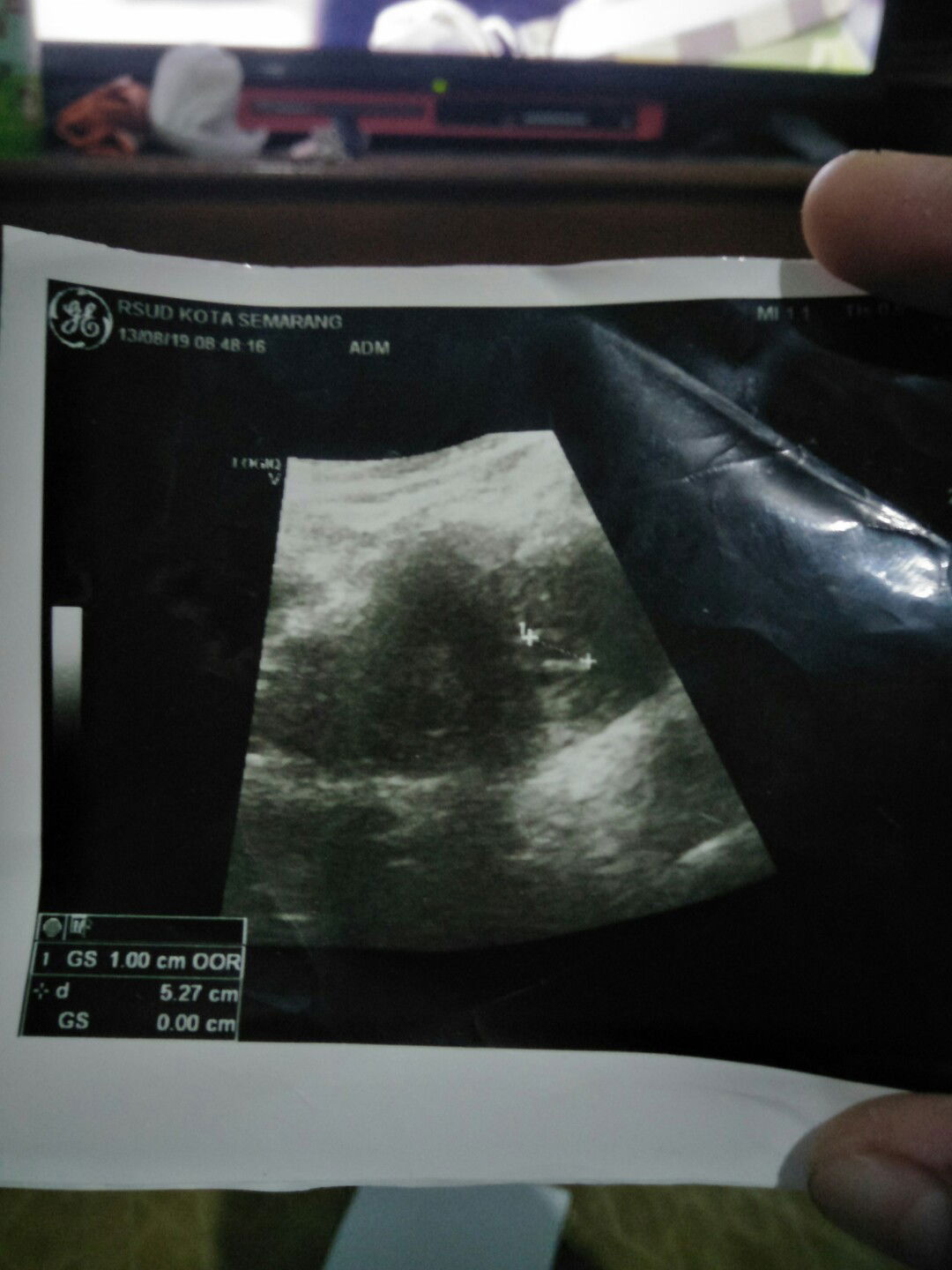 Keguguran/Janin hilang