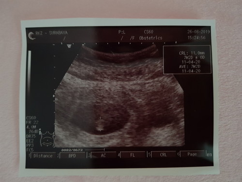 USG sdh terditeksi janin & DJJ legaaa sekalii