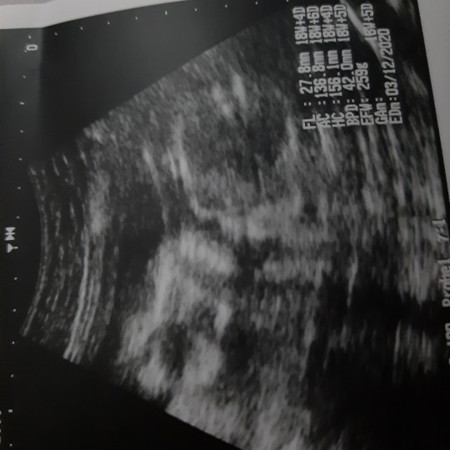 ultrasound