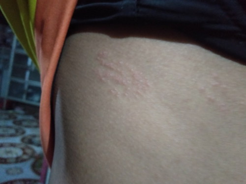 คัยเคยเป็นบ้างค่ะ