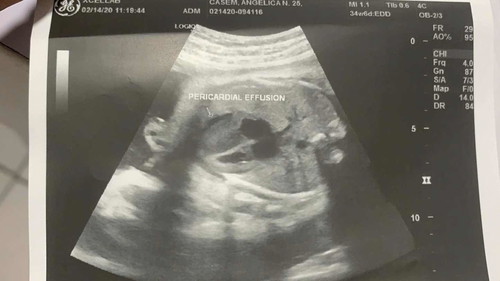 MINIMAL PERICARDIAL EFFUSION