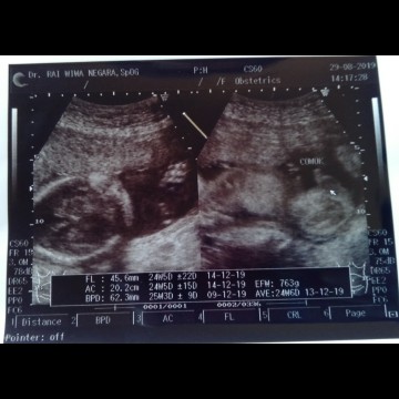 uk 24w lebih kira" hasil usgnya tepat gak ya bun?